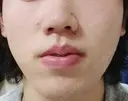 医療脱毛（顔） メンズスキンクリニック 銀座院 DAY 1 サムネイル用