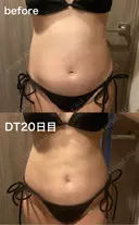脂肪吸引（二の腕） / 脂肪吸引（お腹） / 脂肪吸引（腰） / 脂肪吸引（肩） ルーチェクリニック 銀座院 DAY 20 サムネイル用