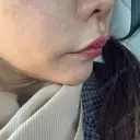 ヒアルロン酸注入（鼻翼基部） ルラ美容クリニック 大宮院 / ルラスキンクリニック 大宮院 DAY 11 サムネイル用