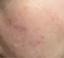 ピコレーザートーニング（美白・かんぱん） / ピコフラクショナルレーザー（毛穴・ニキビ跡） サクラアズクリニック 心斎橋院 DAY 3 サムネイル用