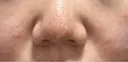 ピコレーザートーニング（美白・かんぱん） / ピコフラクショナルレーザー（毛穴・ニキビ跡） サクラアズクリニック 心斎橋院 DAY 3 サムネイル用