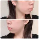 ボトックス（あご） / ボトックス（エラ・小顔） 湘南美容クリニック 新橋銀座口院 DAY 2 サムネイル用