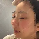 ほくろ・いぼ切除（肌） KARIS beauty clinic DAY 10 サムネイル用