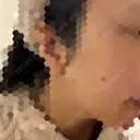 ほくろ・いぼ切除（肌） KARIS beauty clinic DAY 10 サムネイル用