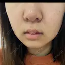ピーリング（ニキビ・毛穴） / ルメッカ ルラ美容クリニック 横浜院 DAY 7 サムネイル用