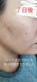 イオン導入 / 毛穴洗浄（ハイドラフェイシャルなど） / ルメッカ ルラ美容クリニック 沖縄院 DAY 20 サムネイル用