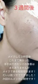 イオン導入 / 毛穴洗浄（ハイドラフェイシャルなど） / ルメッカ ルラ美容クリニック 沖縄院 AFTER サムネイル用