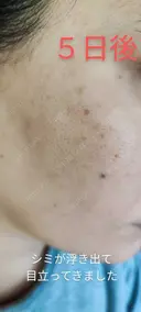 イオン導入 / 毛穴洗浄（ハイドラフェイシャルなど） / ルメッカ ルラ美容クリニック 沖縄院 DAY 20 サムネイル用