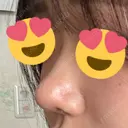 鼻尖形成（切開） / 軟骨移植 / 鼻尖縮小 / 鼻翼基部形成（貴族手術） / ヒアルロン酸注入（鼻翼基部） 東京シンデレラ美容外科 新宿院 DAY 57 サムネイル用