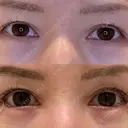 目尻切開 / タレ目形成・グラマラスライン（埋没） LOUIS CLINIC 二子玉川院【ルイクリニック】 DAY 4 サムネイル用