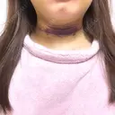 脂肪吸引（顔） TCB東京中央美容外科 新横浜院 DAY 4 サムネイル用