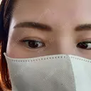 目頭切開 / その他（目元） Leap beauty clinic AFTER サムネイル用