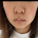 ピーリング（ニキビ・毛穴） / ルメッカ ルラ美容クリニック 横浜院 DAY 8 サムネイル用