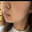 ピーリング（ニキビ・毛穴） / ルメッカ ルラ美容クリニック 横浜院 DAY 8 サムネイル用