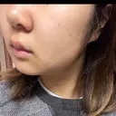 ピーリング（ニキビ・毛穴） / ルメッカ ルラ美容クリニック 横浜院 DAY 9 サムネイル用