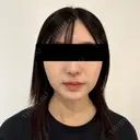 糸リフト / 脂肪吸引（顔） / ジョールファット除去 / 脂肪吸引注射（顔） SEA CLINIC（シークリニック） DAY 70 サムネイル用