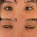 二重切開 / 眼瞼下垂（切開） / 上まぶたたるみ取り ユア美容クリニック 福岡院 DAY 3 サムネイル用