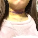 脂肪吸引（顔） TCB東京中央美容外科 新横浜院 DAY 5 サムネイル用