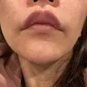 ヒアルロン酸注入（鼻翼基部） ルラ美容クリニック 大宮院 / ルラスキンクリニック 大宮院 DAY 12 サムネイル用