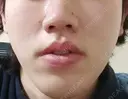 医療脱毛（顔） メンズスキンクリニック 銀座院 AFTER サムネイル用
