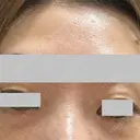 クマ治療 / ボトックス（眉間） / ボトックス（目尻） / ボトックス（額） TCB東京中央美容外科 船橋院 AFTER サムネイル用