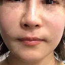 鼻中隔延長（非切開） YBC横浜美容外科 池袋院 DAY 0 サムネイル用
