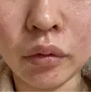 ヒアルロン酸注入（唇） / ヒアルロン酸注入（鼻翼基部） BiBiクリニック DAY 4 サムネイル用