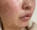 ヒアルロン酸注入（唇） / ヒアルロン酸注入（鼻翼基部） BiBiクリニック DAY 4 サムネイル用
