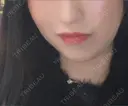 ヒアルロン酸注入（唇） / ヒアルロン酸注入（鼻翼基部） BiBiクリニック DAY 3 サムネイル用