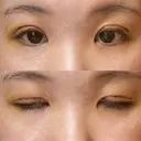 二重切開 / 眼瞼下垂（切開） / 上まぶたたるみ取り ユア美容クリニック 福岡院 DAY 4 サムネイル用