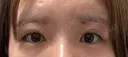 眉下切開 Barbie Clinic DAY 39 サムネイル用