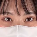 二重埋没 TCB東京中央美容外科 高崎院 AFTER サムネイル用