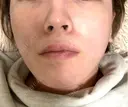 糸リフト / 脂肪吸引（顔） Wing clinic 豊中駅前院 DAY 10 サムネイル用