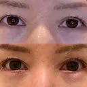 目尻切開 / タレ目形成・グラマラスライン（埋没） LOUIS CLINIC 二子玉川院【ルイクリニック】 DAY 5 サムネイル用