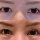 目尻切開 / タレ目形成・グラマラスライン（埋没） LOUIS CLINIC 二子玉川院【ルイクリニック】 DAY 6 サムネイル用