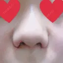 小鼻縮小（切開） ヴェリィ美容形成クリニック DAY 1 サムネイル用