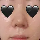 隆鼻術 / 鼻尖形成（切開） / 鼻中隔延長（切開） / 軟骨移植 / 骨切幅寄せ / 鼻翼基部形成（貴族手術） / 鼻柱下降・鼻唇角形成（猫手術） 4Dクリニック DAY 7 サムネイル用