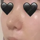 隆鼻術 / 鼻尖形成（切開） / 鼻中隔延長（切開） / 軟骨移植 / 骨切幅寄せ / 鼻翼基部形成（貴族手術） / 鼻柱下降・鼻唇角形成（猫手術） 4Dクリニック DAY 7 サムネイル用