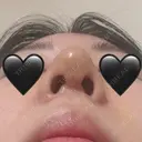 隆鼻術 / 鼻尖形成（切開） / 鼻中隔延長（切開） / 軟骨移植 / 骨切幅寄せ / 鼻翼基部形成（貴族手術） / 鼻柱下降・鼻唇角形成（猫手術） 4Dクリニック DAY 7 サムネイル用