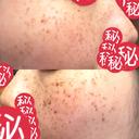 ルメッカ MIO CLINIC 梅田院 DAY 5 サムネイル用