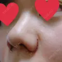 小鼻縮小（切開） ヴェリィ美容形成クリニック DAY 1 サムネイル用