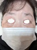 下まぶたたるみ取り / 下まぶたの脂肪取り / 脂肪注入（目の下） アリエル美容クリニック 郡山院 DAY 21 サムネイル用