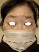 下まぶたたるみ取り / 下まぶたの脂肪取り / 脂肪注入（目の下） アリエル美容クリニック 郡山院 DAY 28 サムネイル用