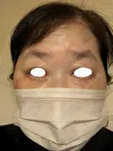 下まぶたたるみ取り / 下まぶたの脂肪取り / 脂肪注入（目の下） アリエル美容クリニック 郡山院 DAY 35 サムネイル用