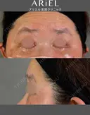下まぶたたるみ取り / 下まぶたの脂肪取り / 脂肪注入（目の下） アリエル美容クリニック 郡山院 DAY 36 サムネイル用