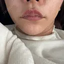 ヒアルロン酸注入（鼻翼基部） ルラ美容クリニック 大宮院 / ルラスキンクリニック 大宮院 DAY 14 サムネイル用