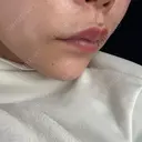 ヒアルロン酸注入（鼻翼基部） ルラ美容クリニック 大宮院 / ルラスキンクリニック 大宮院 DAY 14 サムネイル用