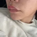 ヒアルロン酸注入（鼻翼基部） ルラ美容クリニック 大宮院 / ルラスキンクリニック 大宮院 DAY 14 サムネイル用