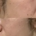 ルメッカ 東京美容外科 福岡院 AFTER サムネイル用