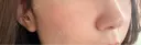 ヒアルロン酸注入（鼻翼基部） KIMI CLINIC 形成・美容外科 DAY 0 サムネイル用